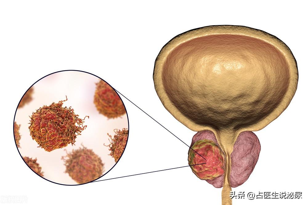 前列腺钙化是什么病_前列腺炎有什么症状_前列腺在哪里